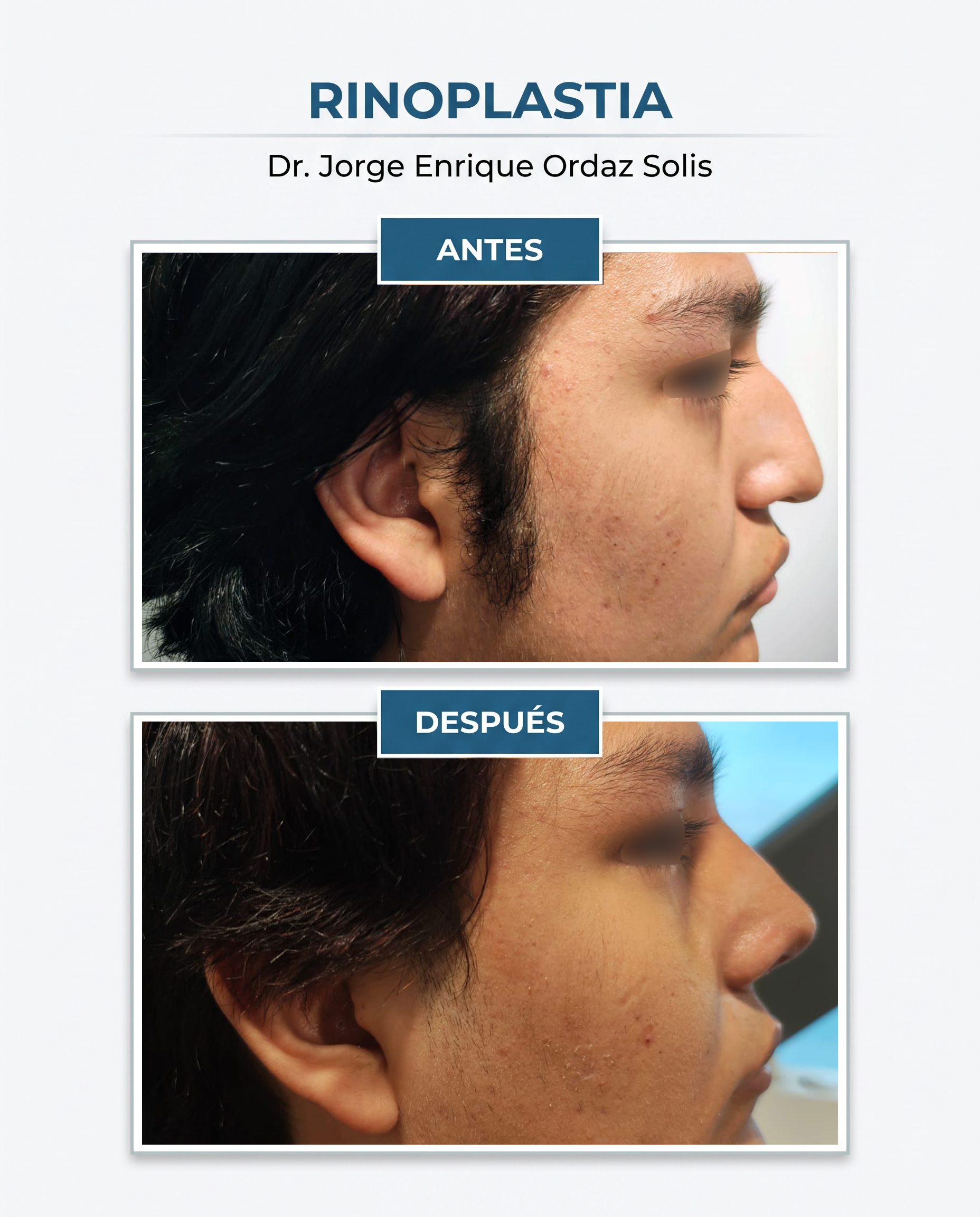 Resultado de rinoplastía, Caso 1