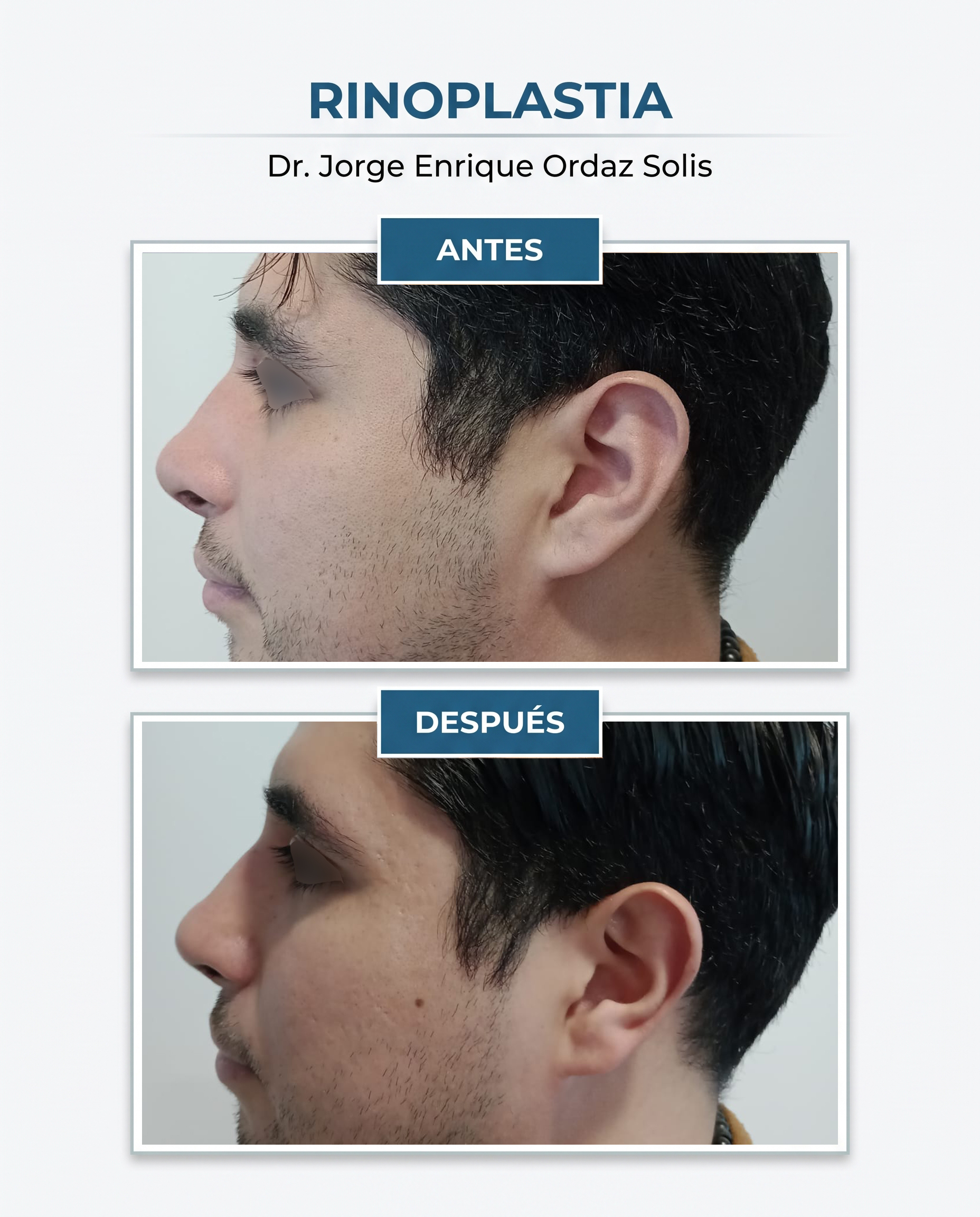 Resultado de rinoplastía, Caso 8